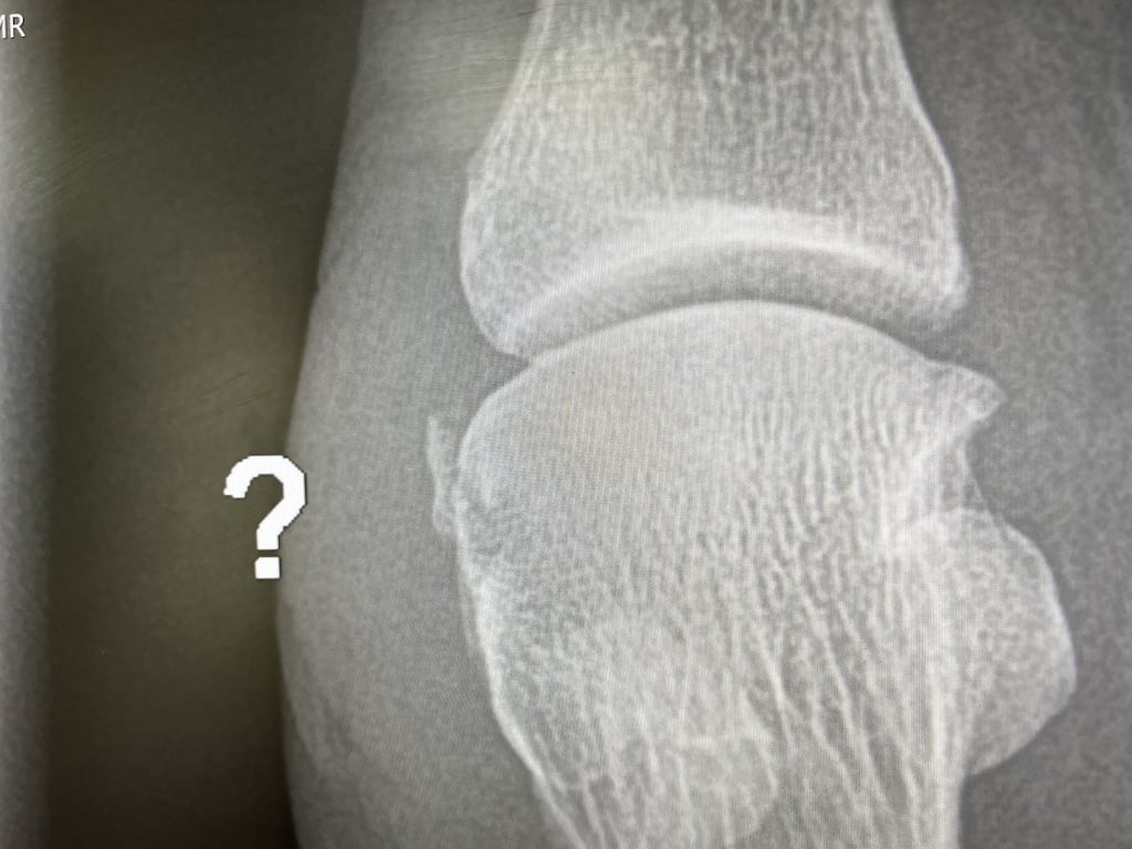 X-ray of my broken toe